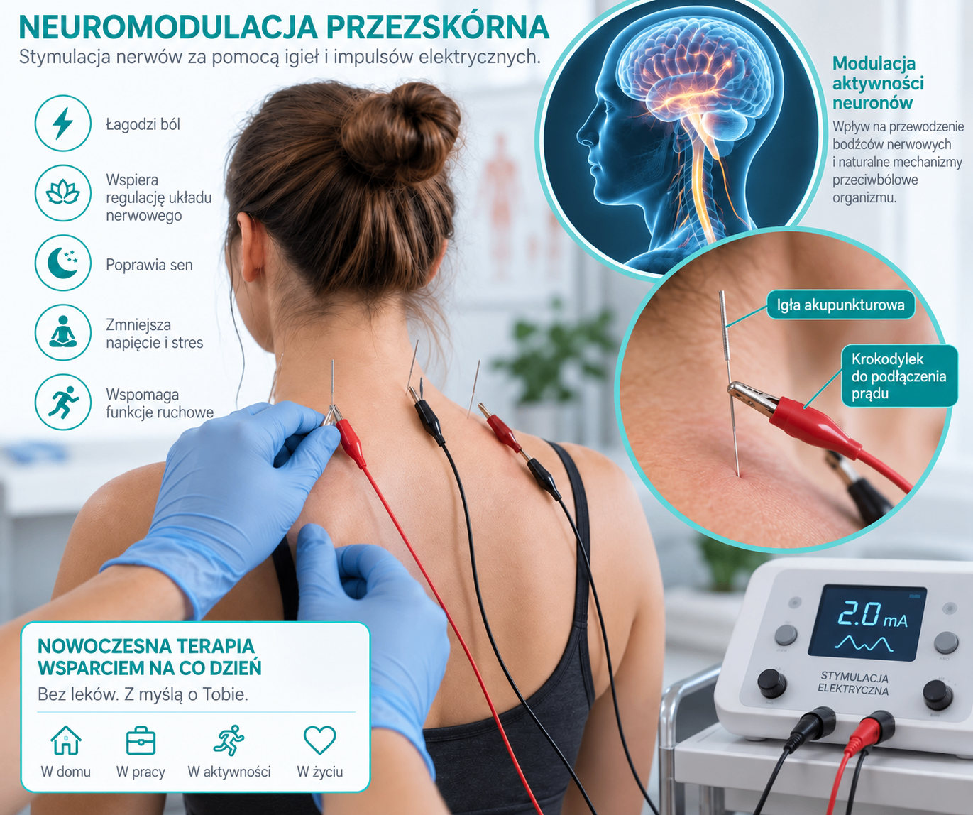 Infografika Przezskórnej Neuromodulacji — działanie, zastosowanie i efekty terapii